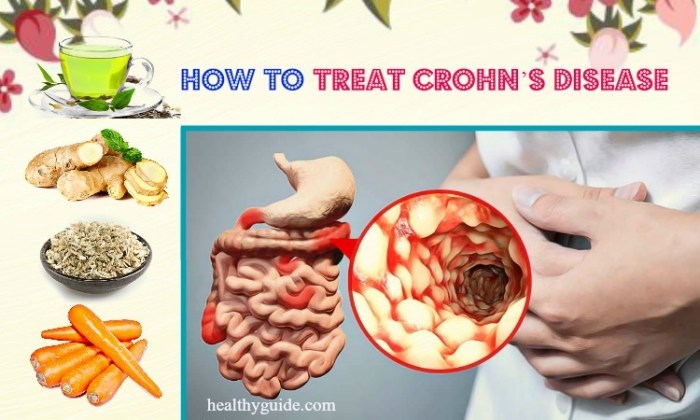 Is there any natural treatment for Crohn's disease?