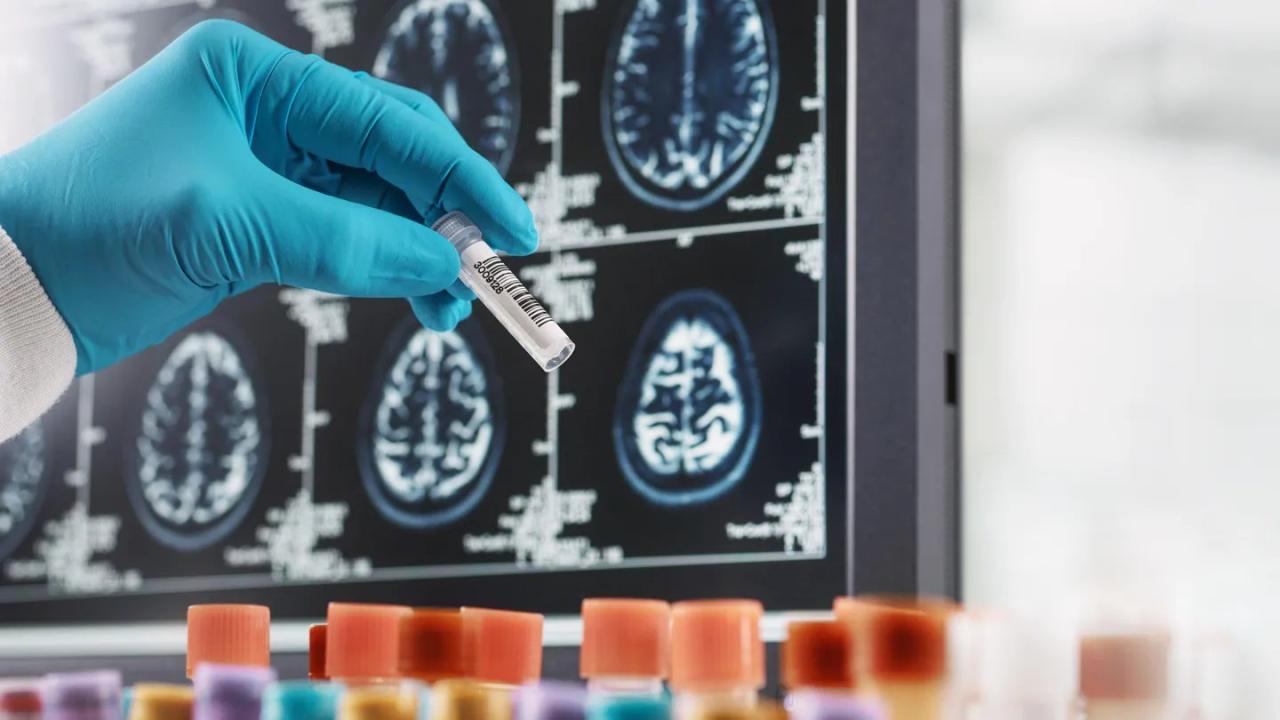 What Are the Latest Trends in Multiple Sclerosis Treatment?